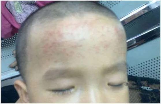 退热贴的真正功效是“安慰剂”，多少中国父母都上当了，并没有用