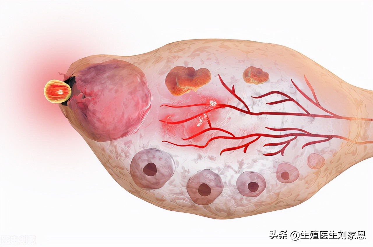 卵泡成熟了却排不出来是闹哪样？快来听生殖医生讲讲真正原因