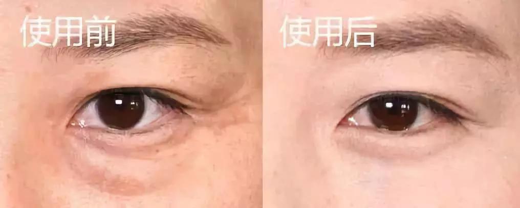 眼袋越来越严重怎么救,有眼袋显老十岁一招教你消除