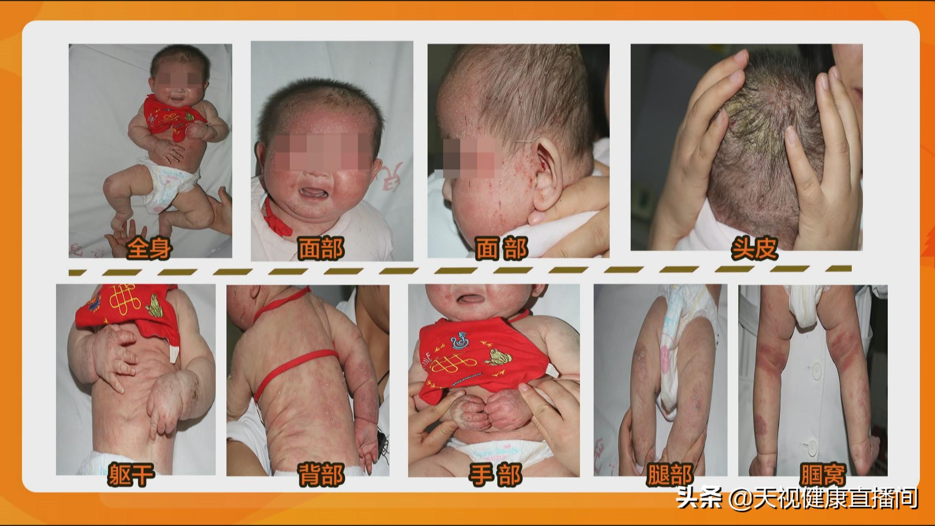 预防和缓解小儿湿疹，这些办法管用