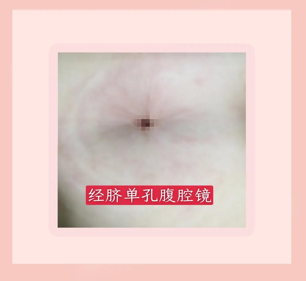 单孔手术优点,单孔手术的效果