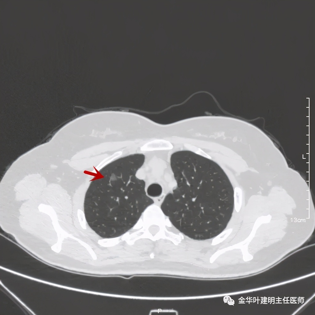 左肺上叶在ct影像上怎么看,平扫ct可以看出肺肿瘤的变化吗
