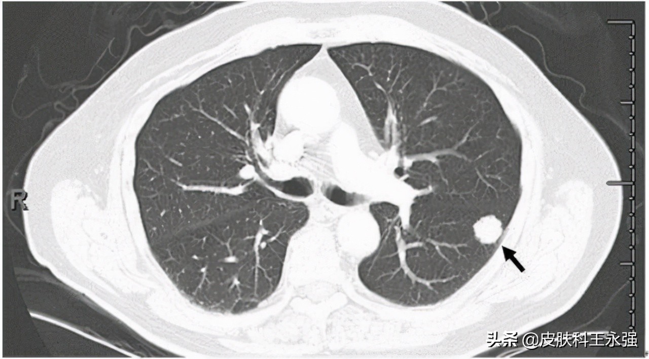 乳腺癌术后又发现肺结节，是转移还是原发肺癌？