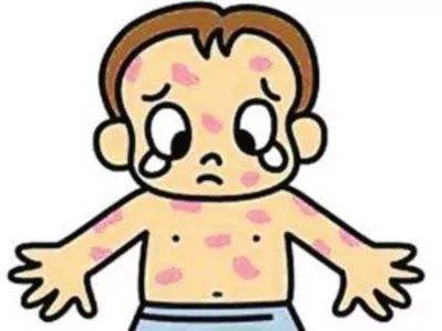 猩红热后期一定要验尿吗,猩红热需要上报么