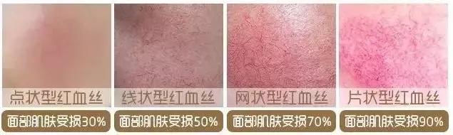 泛红期的红血丝怎么治疗,泛红的红血丝几天能好