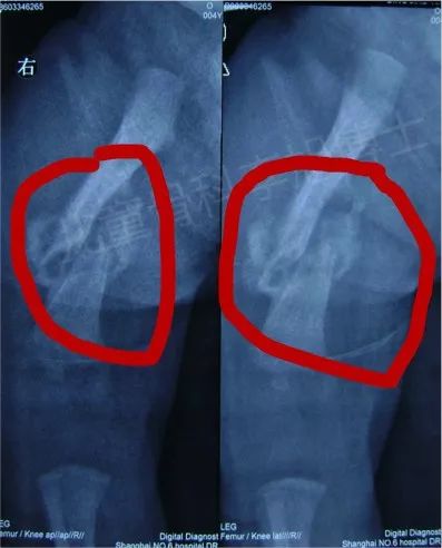 婴儿股骨骨折会有后遗症吗,六个月婴儿右股骨骨折