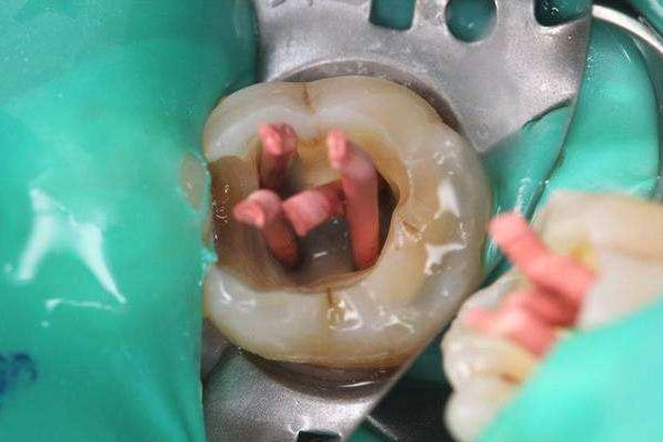 蛀牙在疼痛时期可以治疗吗,蛀牙早期不疼的时候怎么治疗