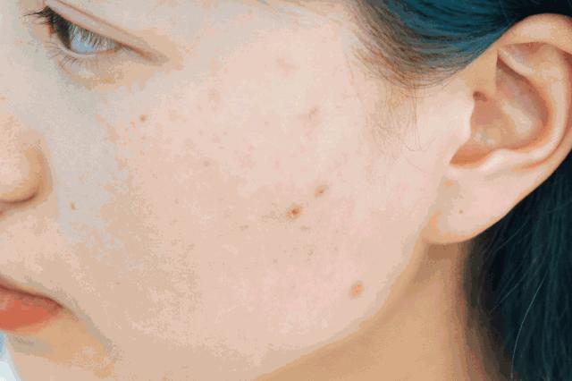 洋葱可以祛痘痘吗 (洋葱祛痘印的最好方法)