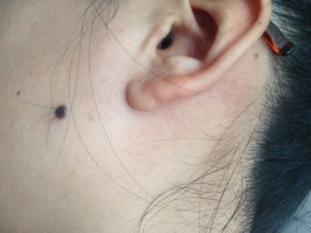 小儿色素沉着能消退吗,小孩子的色素痣着急处理吗