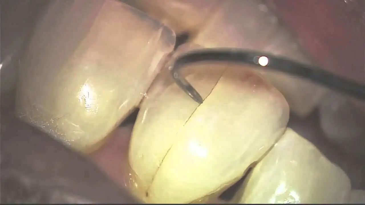 牙齿有裂纹出现是因为什么原因,牙齿有细微裂纹是什么原因