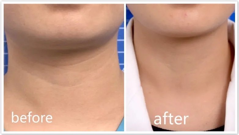 18岁的脸40岁的脖子，你们要的去颈纹指南来啦