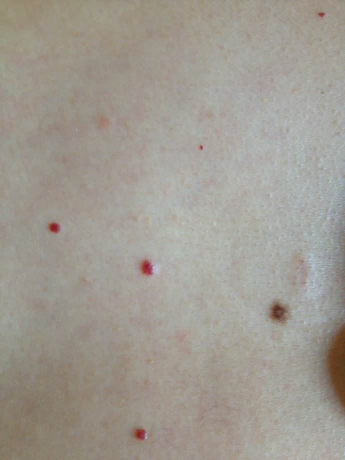 点痣需要注意面相吗,点痣风水学上哪些痣是好的