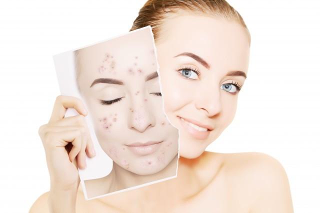 怎么祛痘印最快最有效的方法,怎么祛痘印的最有效方法