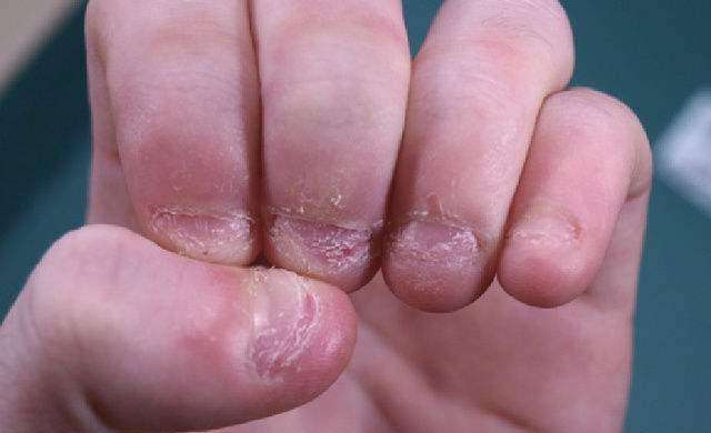 孩子咬指甲怎么办快速解决方法,孩子咬指甲怎么心理疏导