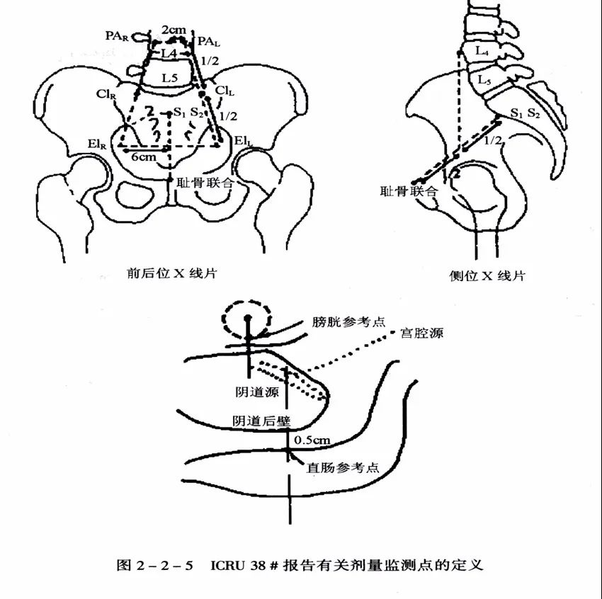 近距离放疗的副作用,近距离放疗