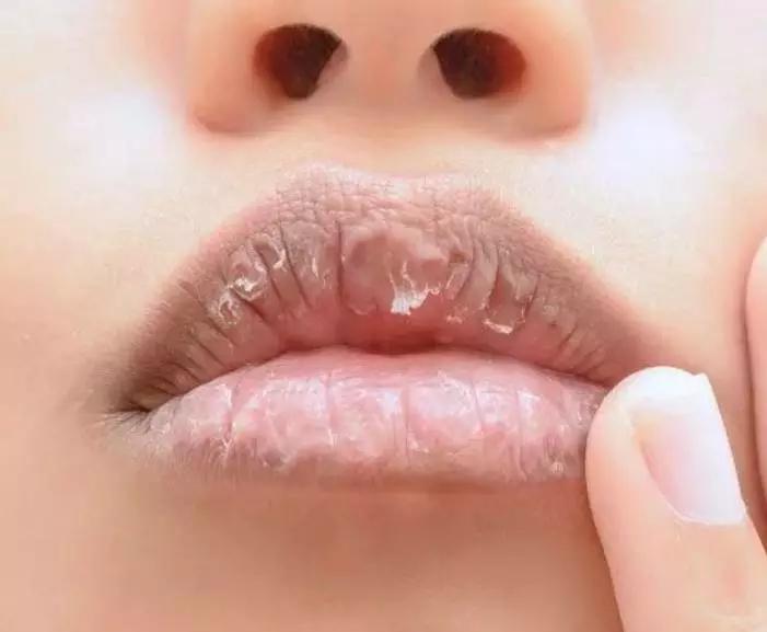 轻松解决干裂冻裂打造水润嘟嘟唇,嘴唇干裂起皮一招立刻变水润