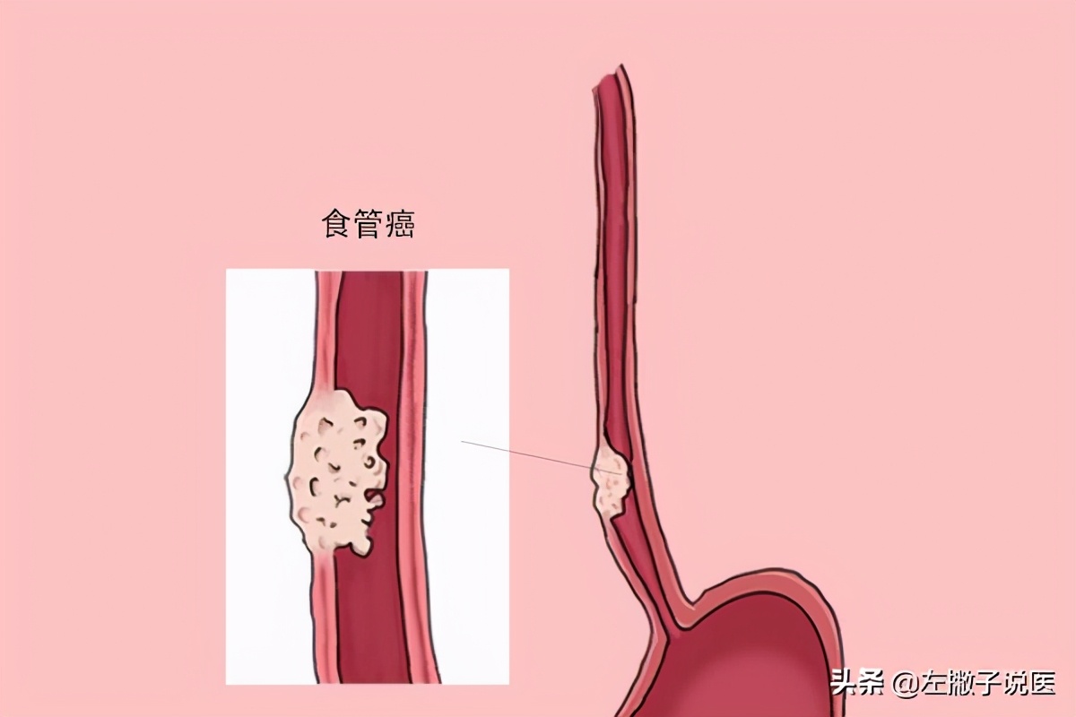 喝多少度的热水致癌,喝多少度热水致癌