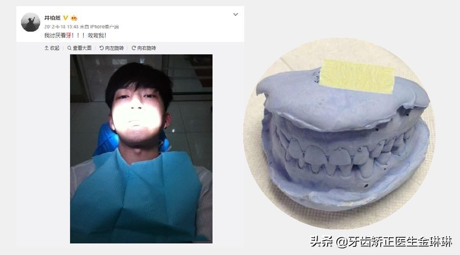 明星全口烤瓷牙的危害,明星为什么都做烤瓷牙