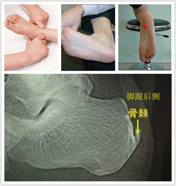 后脚跟疼怎么办快速缓解,后脚跟疼痛是肾虚吗