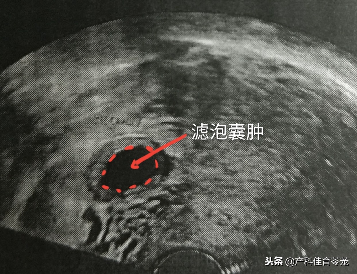 卵巢囊肿是黄体囊肿吗,盆腔囊肿是卵巢囊肿吗