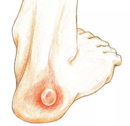 跑步脚上起水泡怎么处理好得快,脚跑步起水泡怎么处理好得快