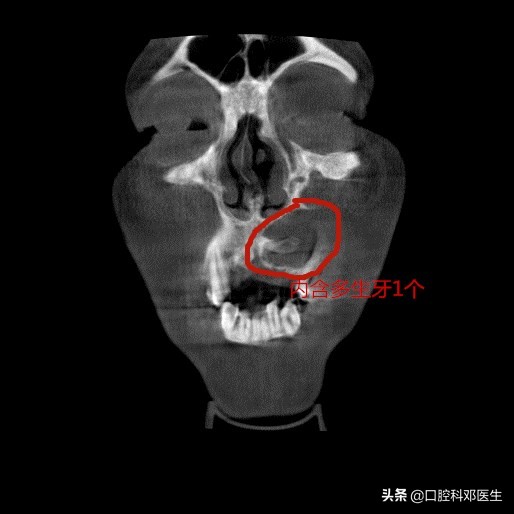 水平阻生埋伏牙真实拔除过程,埋伏阻生牙一辈子不拔行吗