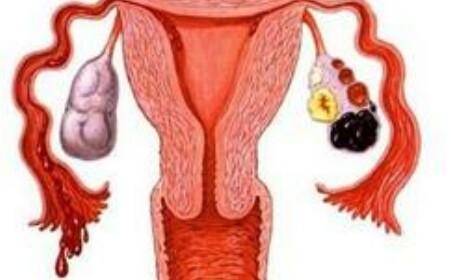 月经期拉肚子是怎么回事,经期腹泻是什么原因造成的