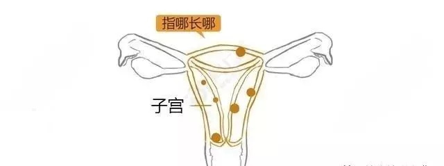 子宫肌瘤动漫演示,子宫肌瘤是什么原因导致的漫画