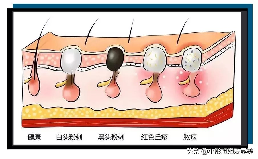 自发泡清洁黑头粉刺小气泡面膜,小气泡去黑头粉刺清洁神器好不好
