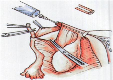 内痔怎么治，教你这个小妙招，让你不再菊花残