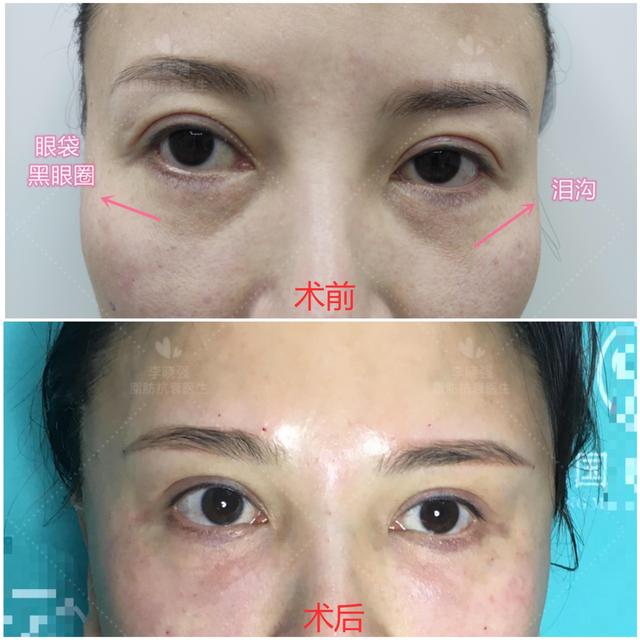 女生面部凹陷自救,女生面部凹陷