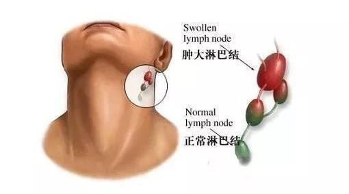 患癌的原理,癌症早期伪装成咽炎
