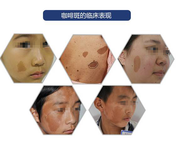 宝宝脸上咖啡斑治不好吗,咖啡斑为什么治不好