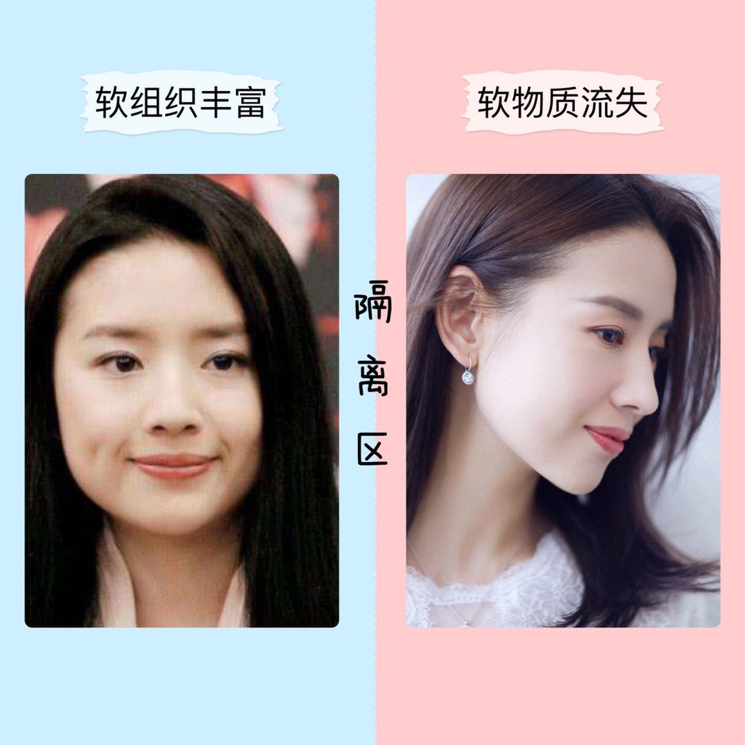 还不到30岁的郑爽，法令纹就这么明显了？*力暴**按摩，她的脸没事吧