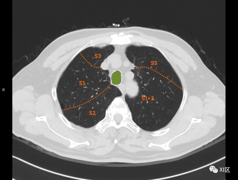 如此详细的肺部影像解剖，有点儿酷
