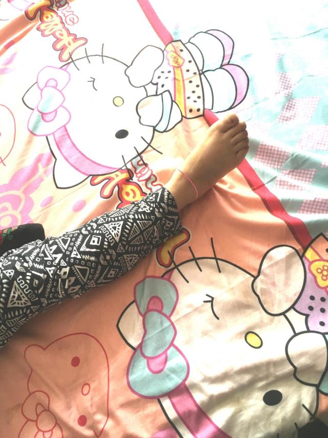 脚腕扭伤恢复后脚腕变粗活动受限,脚腕扭伤了怎么恢复最快