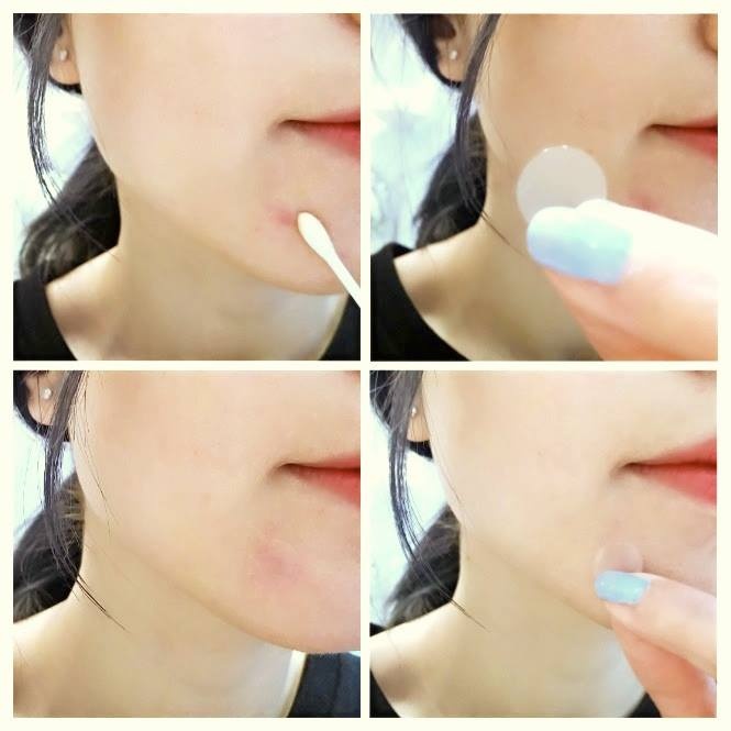 修丽可哪一款适合痘印,修丽可哪款精华祛痘印闭口好用