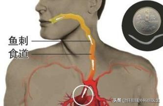 有鱼刺在喉咙里怎么办,有鱼刺扎到手怎么办