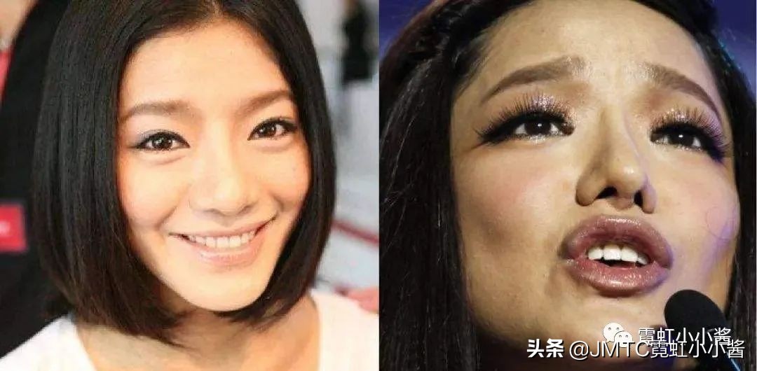 鼻子怎么修复好看呢,鼻型修复方法大全