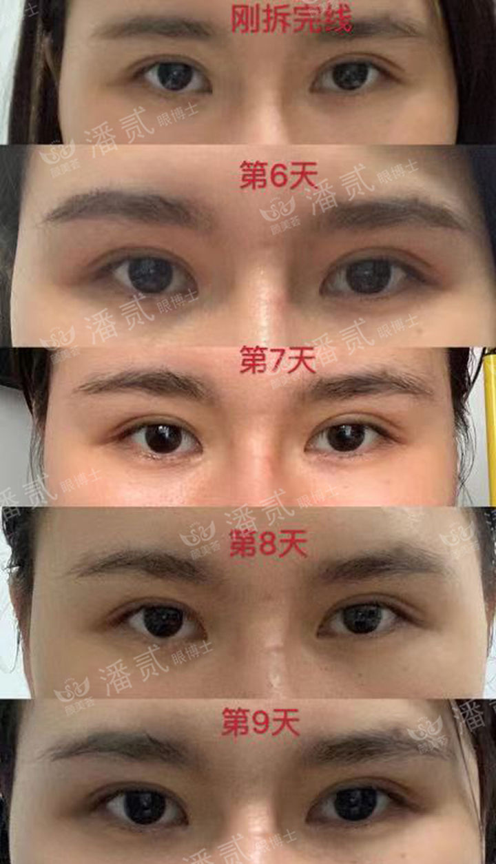 原来双眼皮不好看有必要继续割吗,割双眼皮是不是越修复越难看