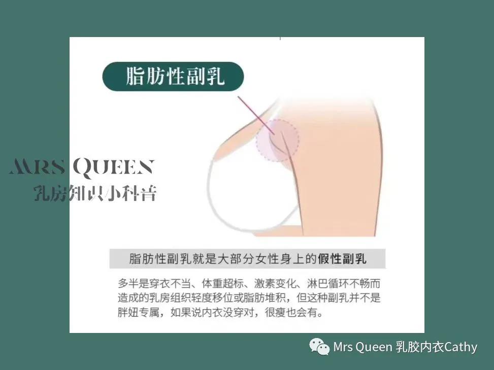 刚刚才长的副乳还很小怎么治疗,腋下有一个大大的副乳怎么办