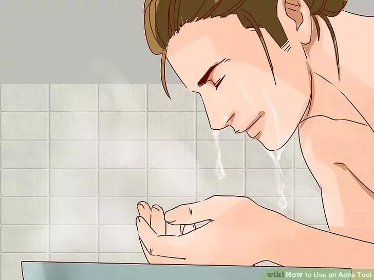 针清祛痘一般多少钱一次,针清祛痘后可以涂甲硝唑吗