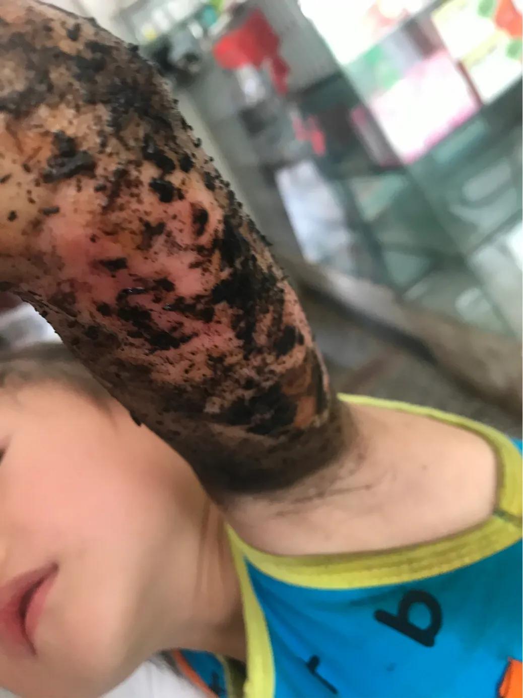 当女儿被严重烫伤疼痛难忍,幼儿园女孩被烫伤治疗过程