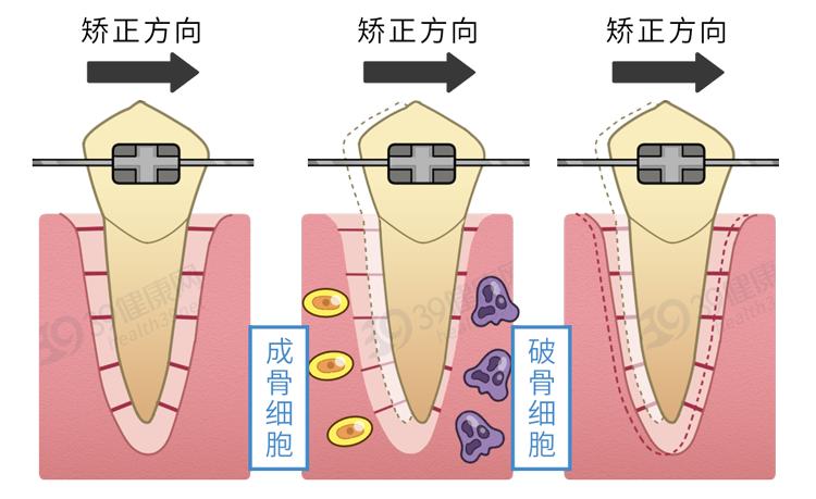 隐形牙套能矫正整齐吗,为什么戴牙套会让人变好看