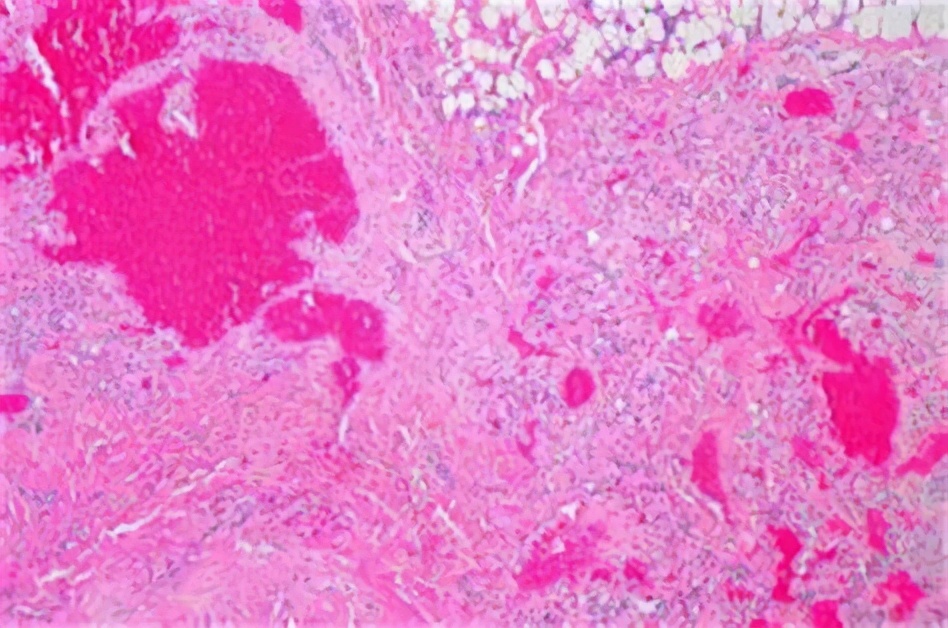 为什么肝血管瘤医生建议不用管,有了肝血管瘤要注意什么