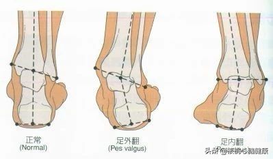 中风患者足内翻怎么矫正,中风足内翻自我矫正训练