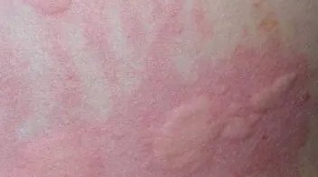 长期皮肤问题困扰的你,3种皮肤问题要重视