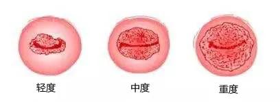 宫颈糜烂能治好吗能痊愈吗,宫颈糜烂能治好吗需要多久