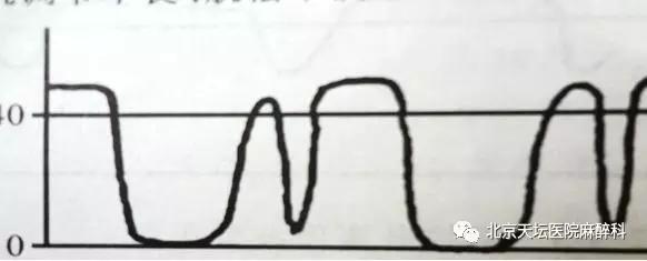 常见呼吸类型有哪几种,呼吸少量二氧化碳有什么症状