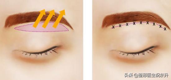 与大家聊一聊的技巧,做提眉手术后应该注意哪些事项